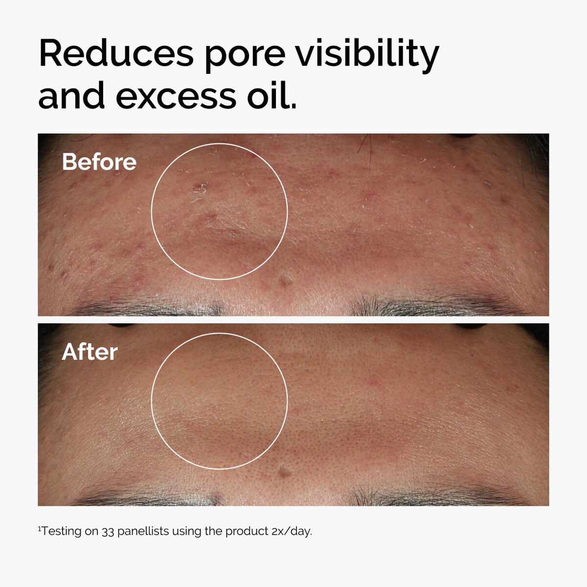 niacinamide-10-zinc-1-a5 ord-niacinamide-zinc-blemish-serum-before-after-pores.jpg