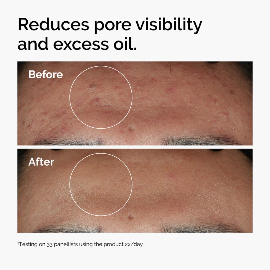 niacinamide-10-zinc-1-a5 ord-niacinamide-zinc-blemish-serum-before-after-pores.jpg