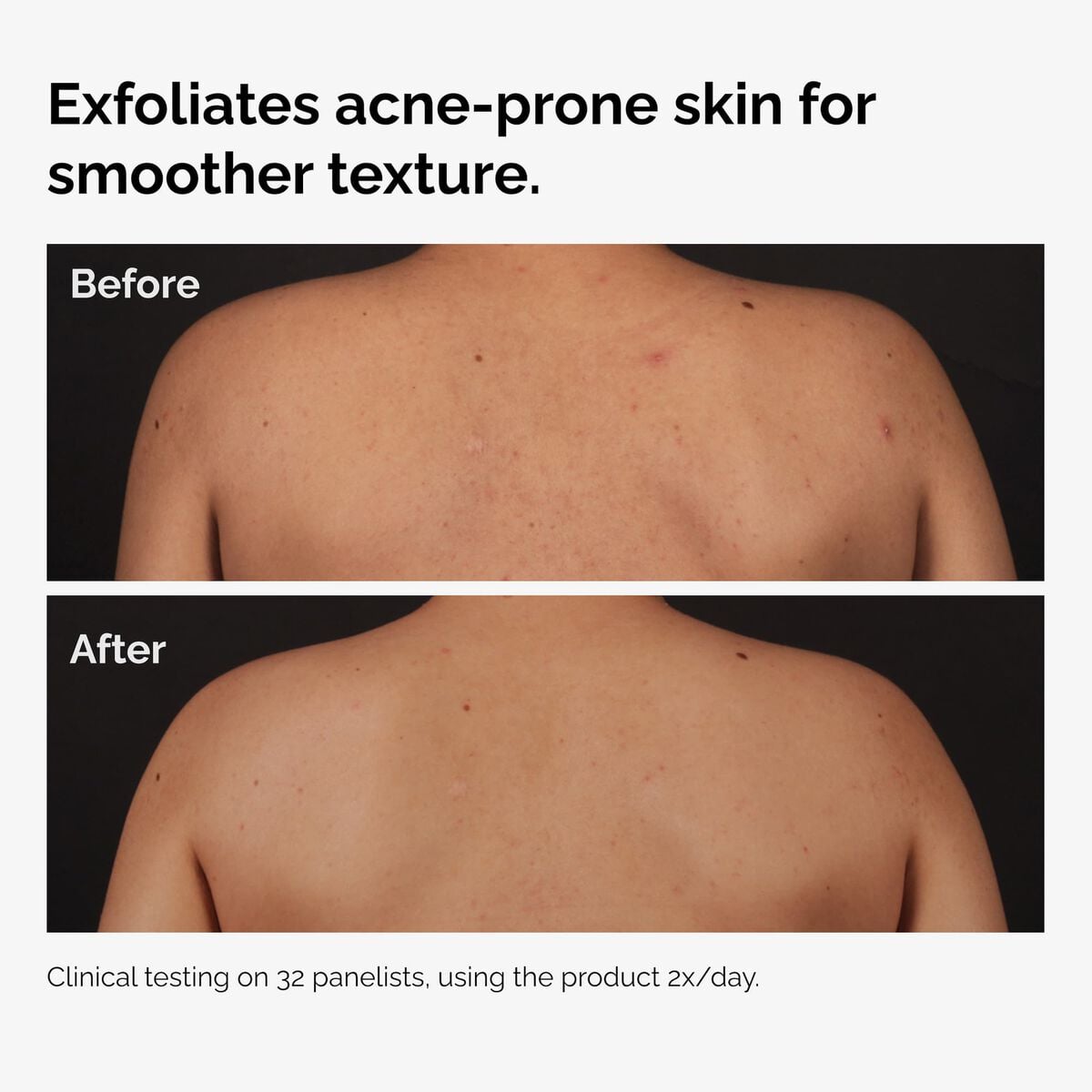 salicylic-acid-0-5-body-serum-i3 ord-salicylic-acid-body-serum-before-after-graphic-NA.jpg